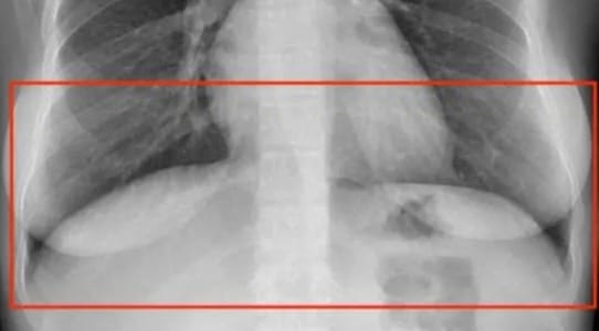 Transparent Occlusion in Medical Images