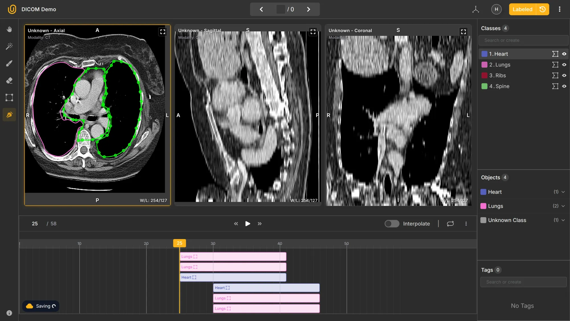 Example of CT slice annotation showing lungs and heart segmentation in Unitlab Annotate